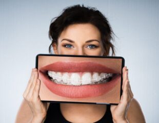 تصویر زنی با ارتودنسی سرامیکی