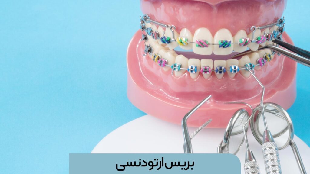 بریس ارتودنسی