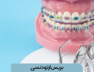 بریس ارتودنسی