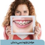 مراحل ارتودنسی دندان