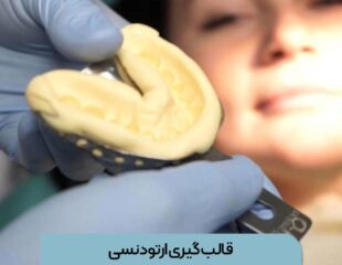 قالب گیری ارتودنسی