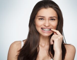 تصویر یک زن جوان با بریس ارتودنسی بر روی دندان هایش